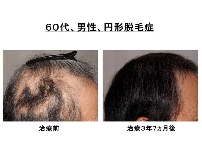 円形脱毛症　病院